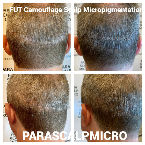 Scalp Micropigmentation (SMP) to Refine your Hair Transplant