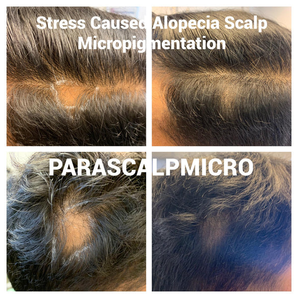 Stress causes Hair Loss / Alopecia Areata Fix by Scalp Micropigmentation Hair Tattoo