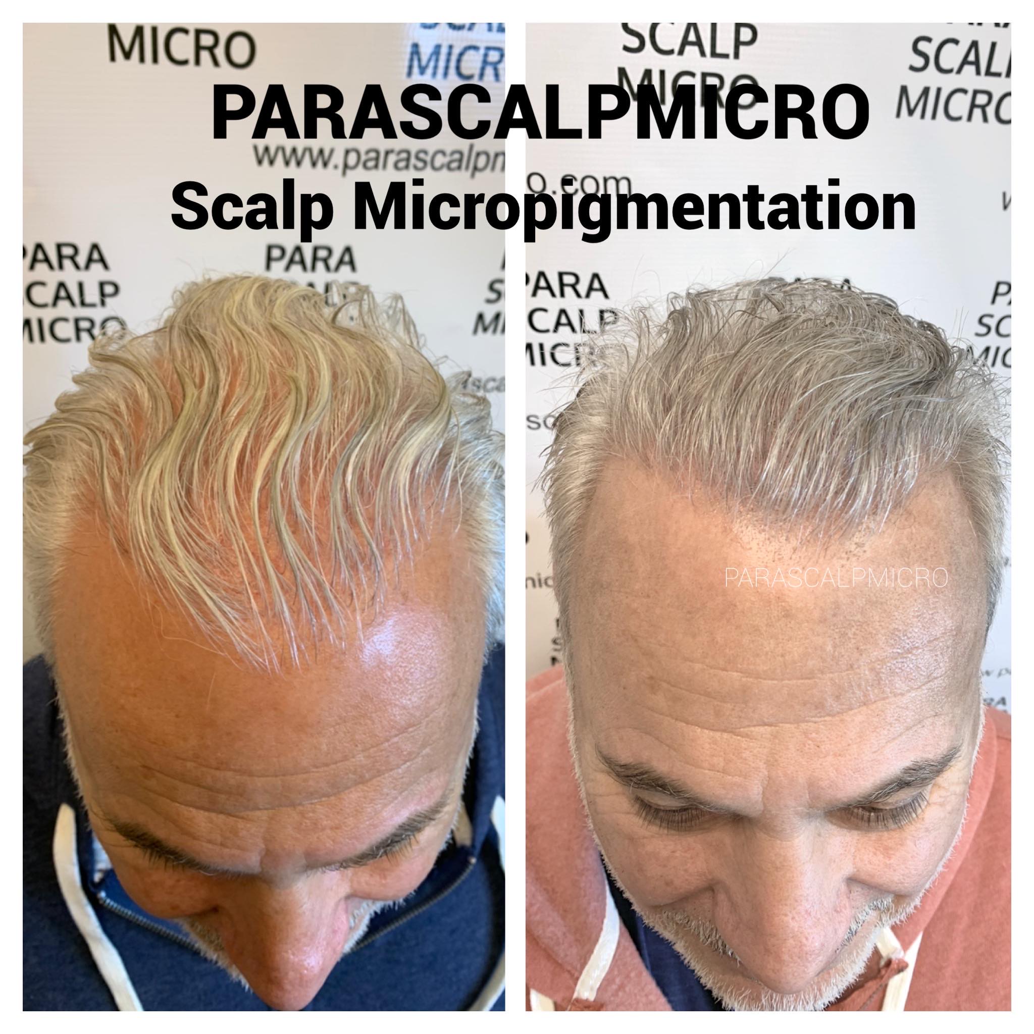 Hair Tattooing Twin Cities - Scalp Micropigmentation | Medical Tattoo  Center of America