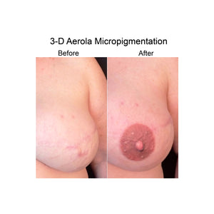 Nipple Tattoo Two Areolas Micropigmentation Paramedical - PARASCALPMICRO INSTITUTE